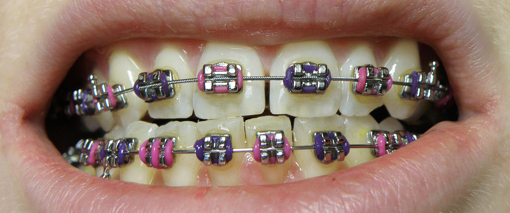 Dental Braces &amp; Orthodontic Treatment | Teeth Braces - Dr. Bhalla