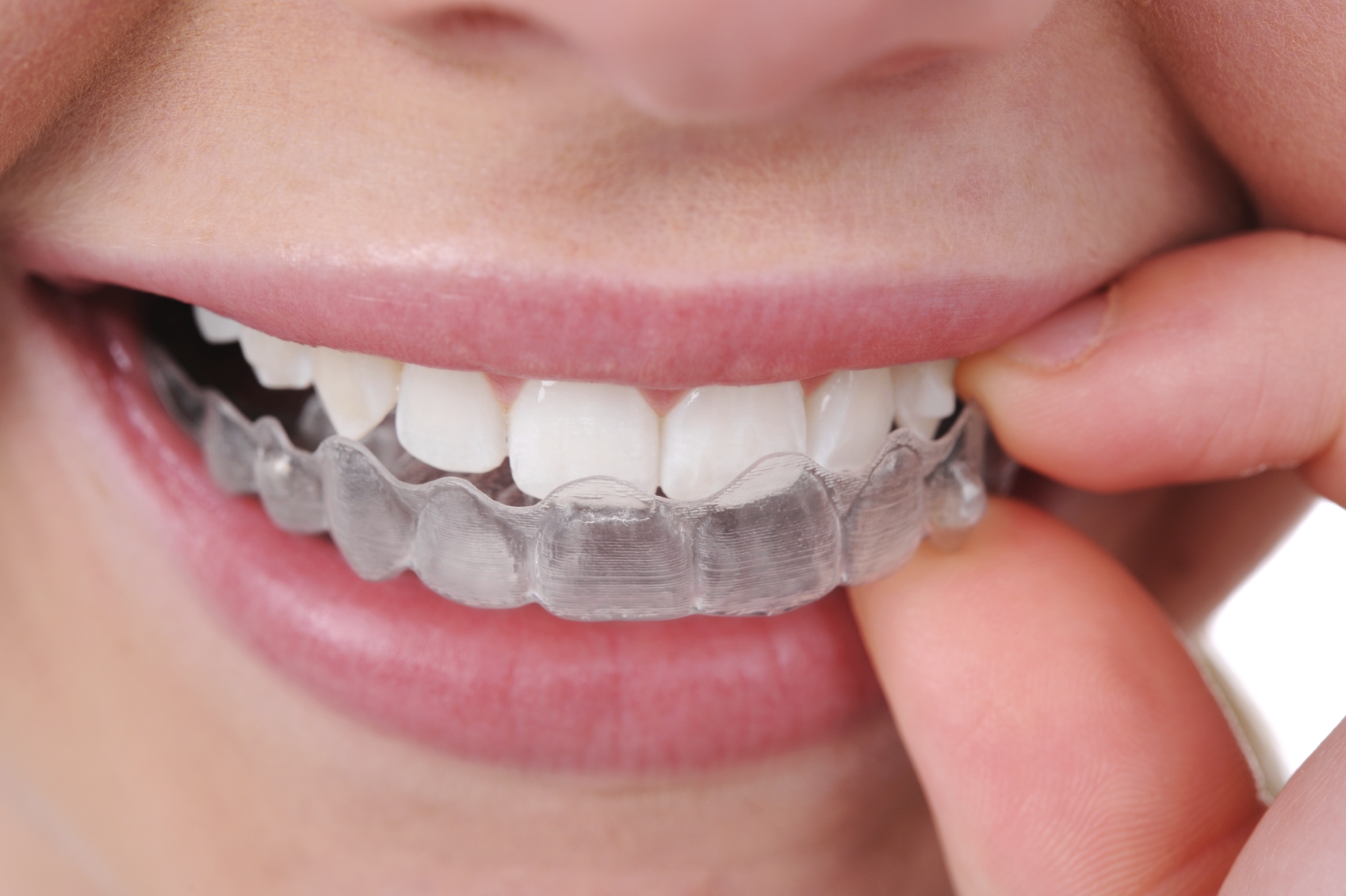 Dental Braces & Orthodontic Treatment | Teeth Braces - Dr. Bhalla