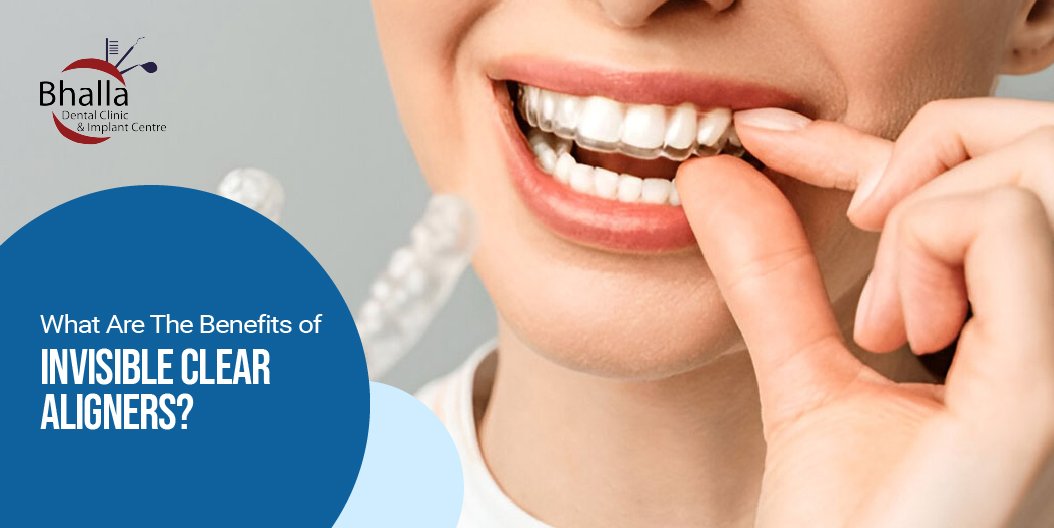What are the Benefits of Invisible Clear Aligners?