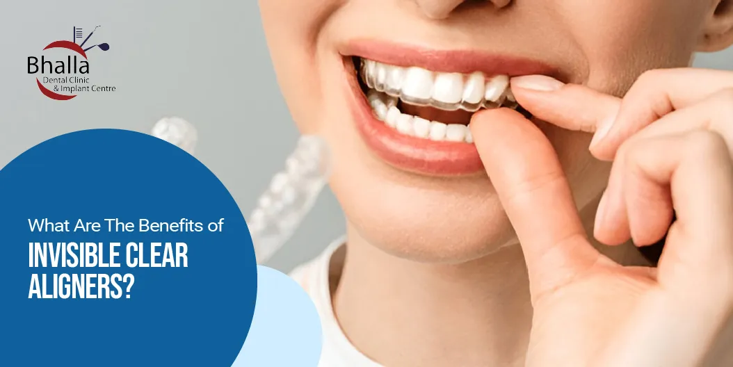 Benefits of Invisible Clear Aligners