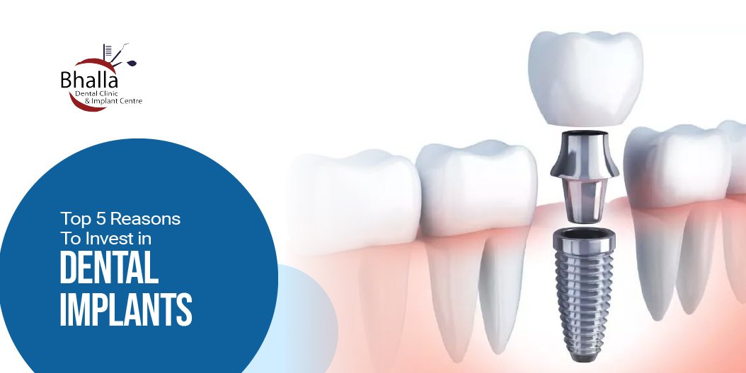 Top 5 Reasons to Invest in Dental Implants