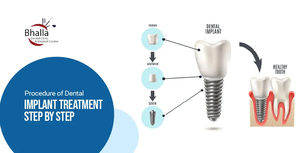Dental Implant Treatment