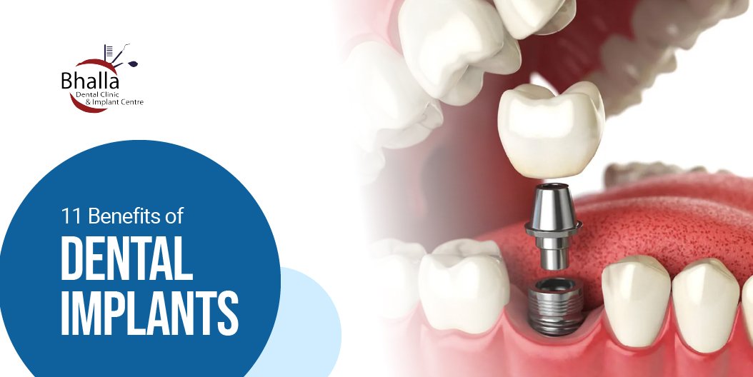 11 Key Benefits of Dental Implants