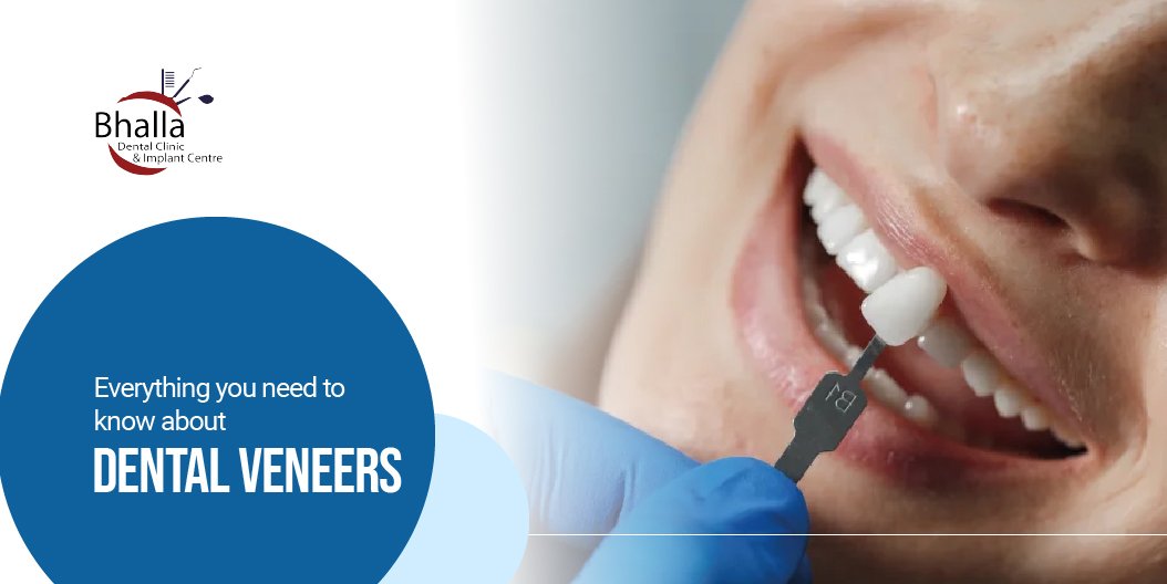 Everything You Need to Know About Dental Veneers
