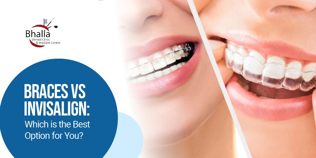 Braces vs. Invisalign: Which is The Best Option for You?
