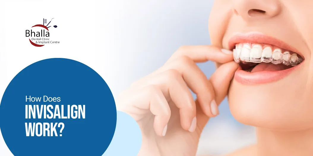 Invisalign Work