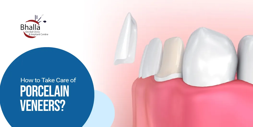 Porcelain Veneers