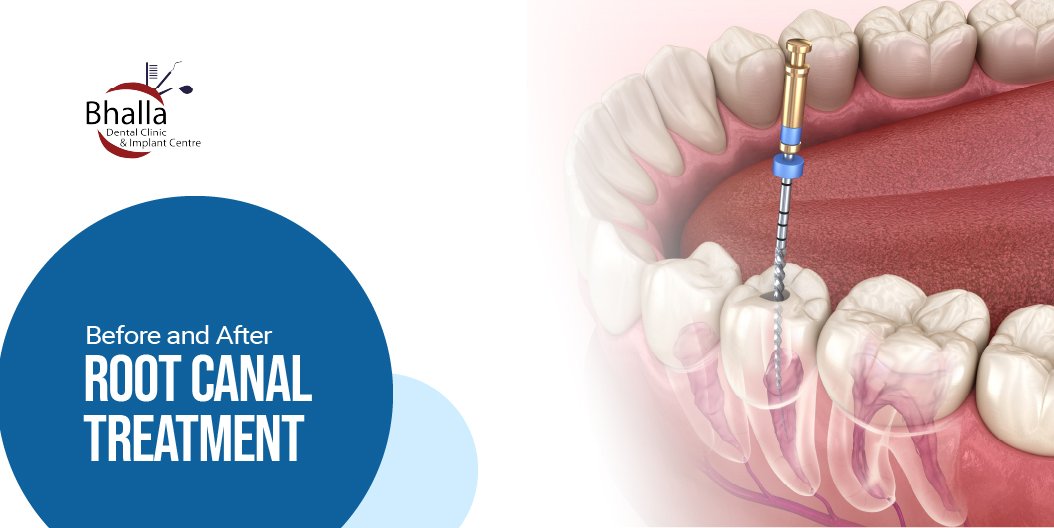 Root Canal Treatment Before and After