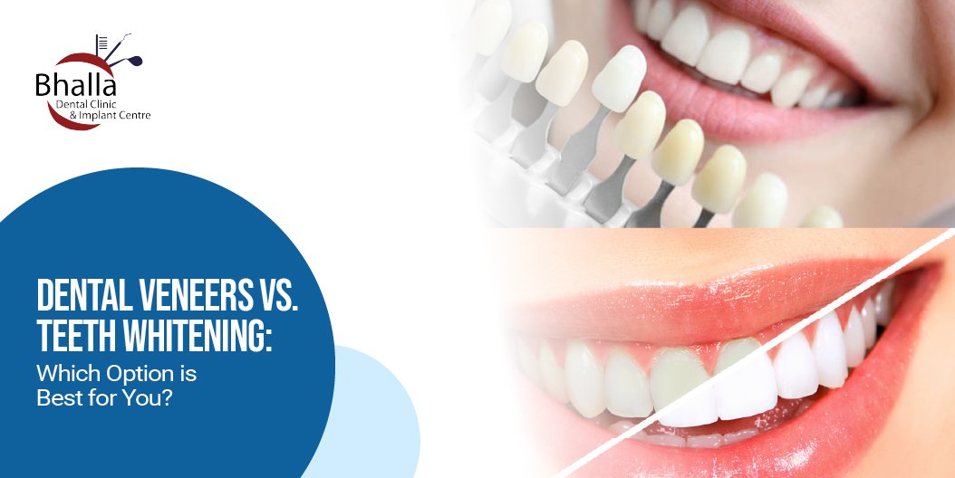 Dental Veneers Vs. Teeth Whitening: Which Option is Best for You?
