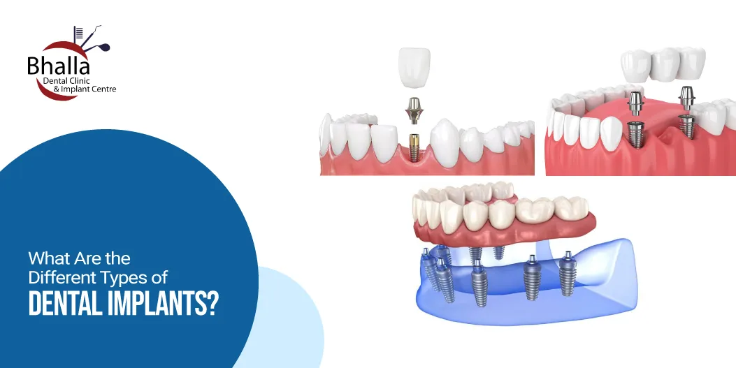 Types of Braces