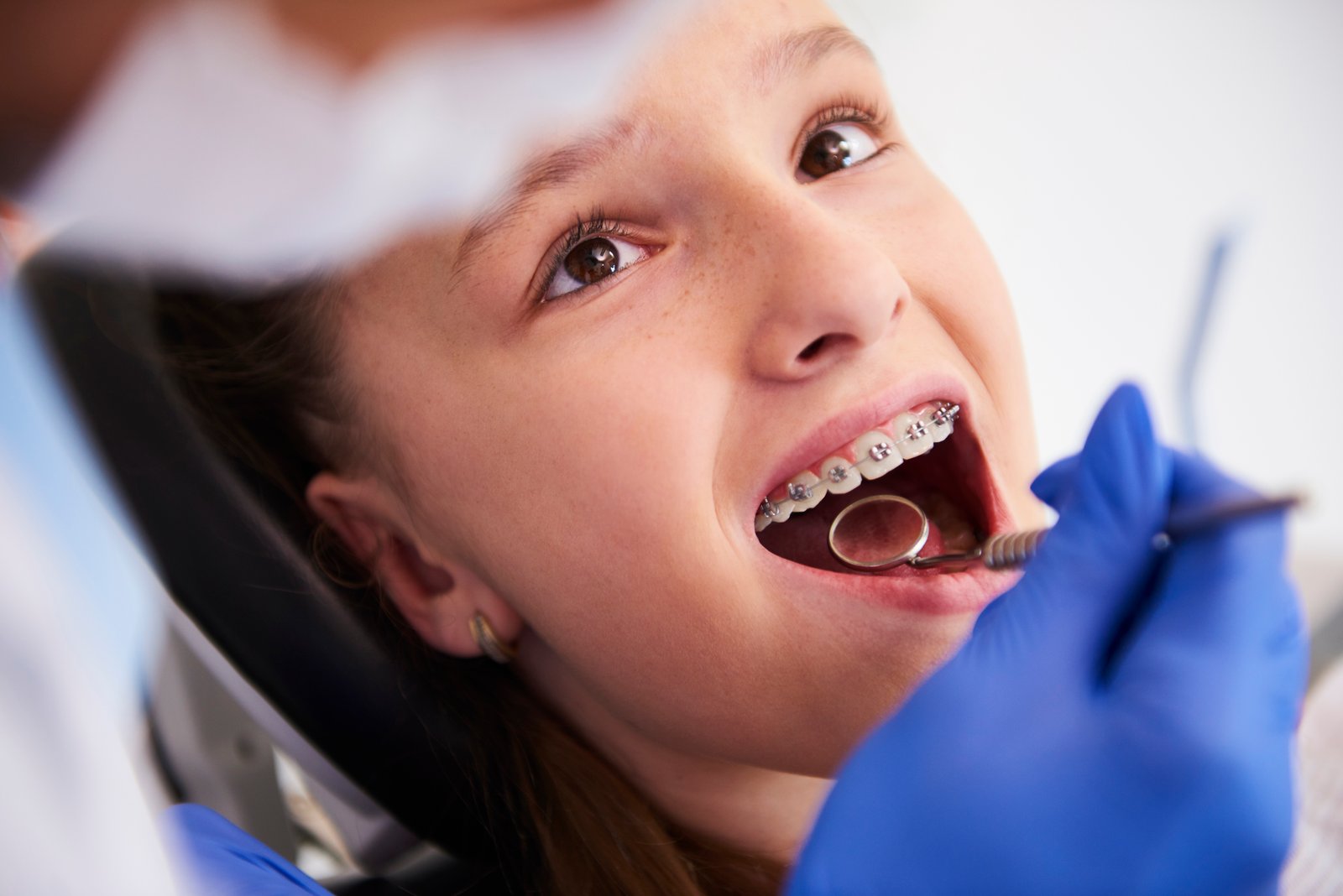 Dental Braces Tretament in Ahmedabad