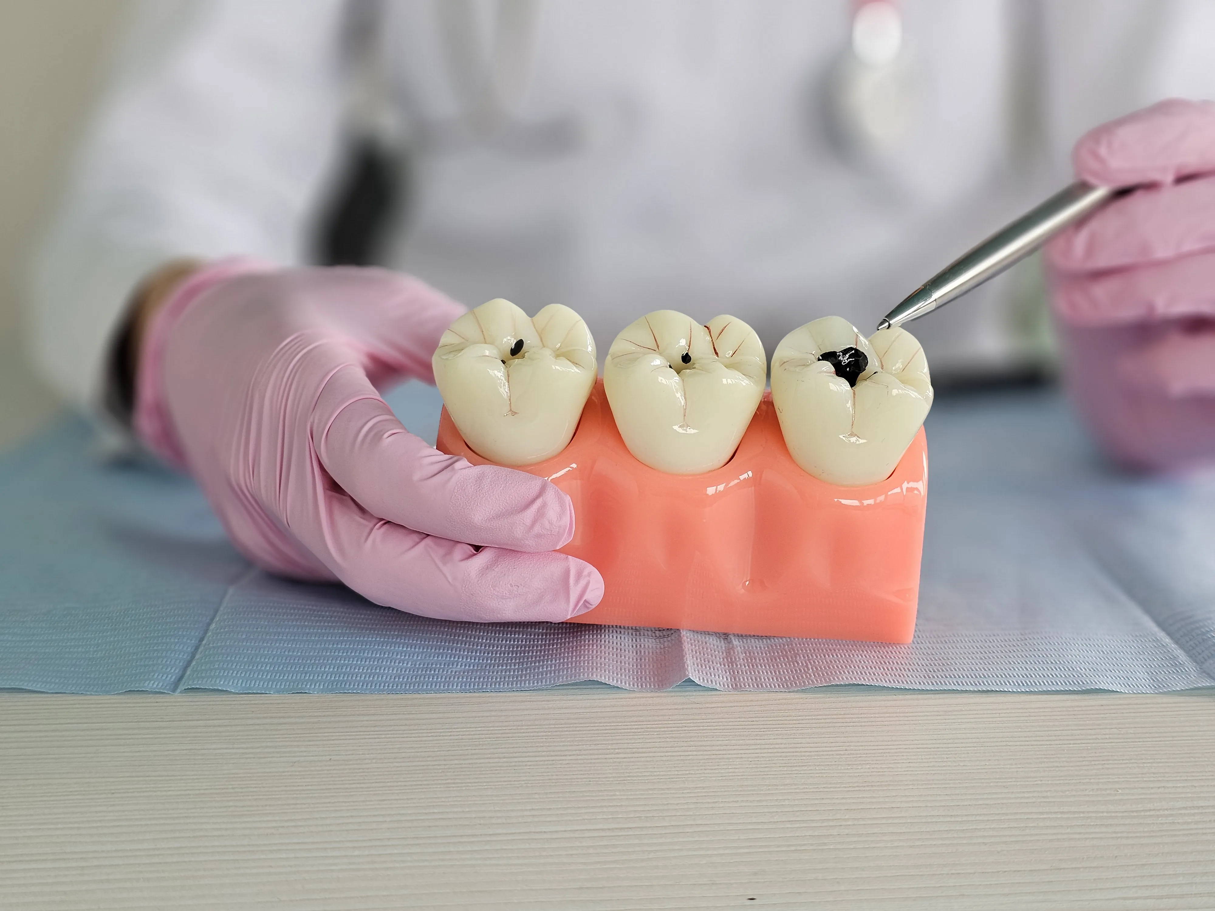 Dental Filling Treatment in Ahmedabad