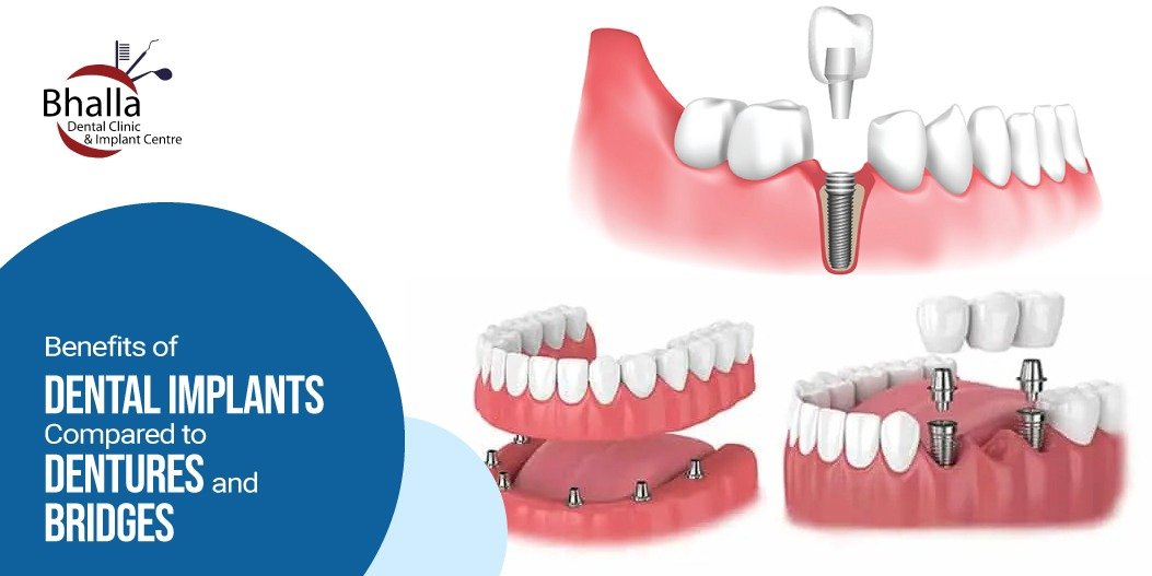 Benefits of Dental Implants