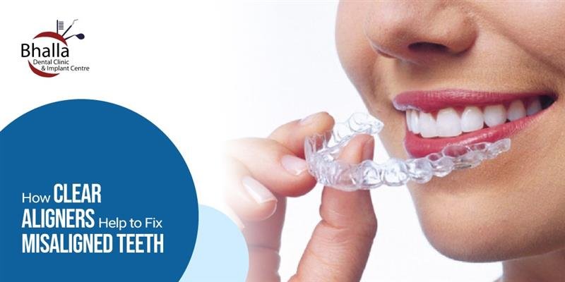 How Clear Aligners Help to Fix Misaligned Teeth