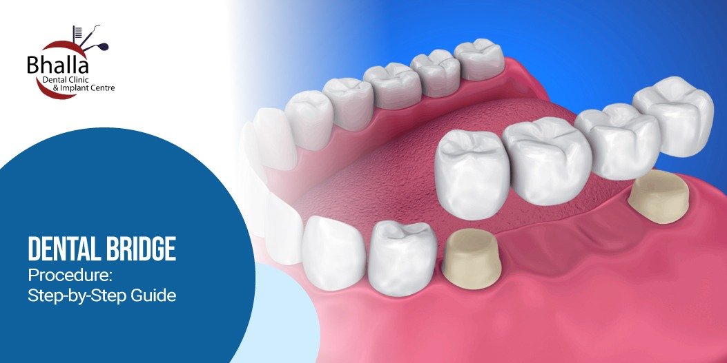 Dental Bridge Procedure