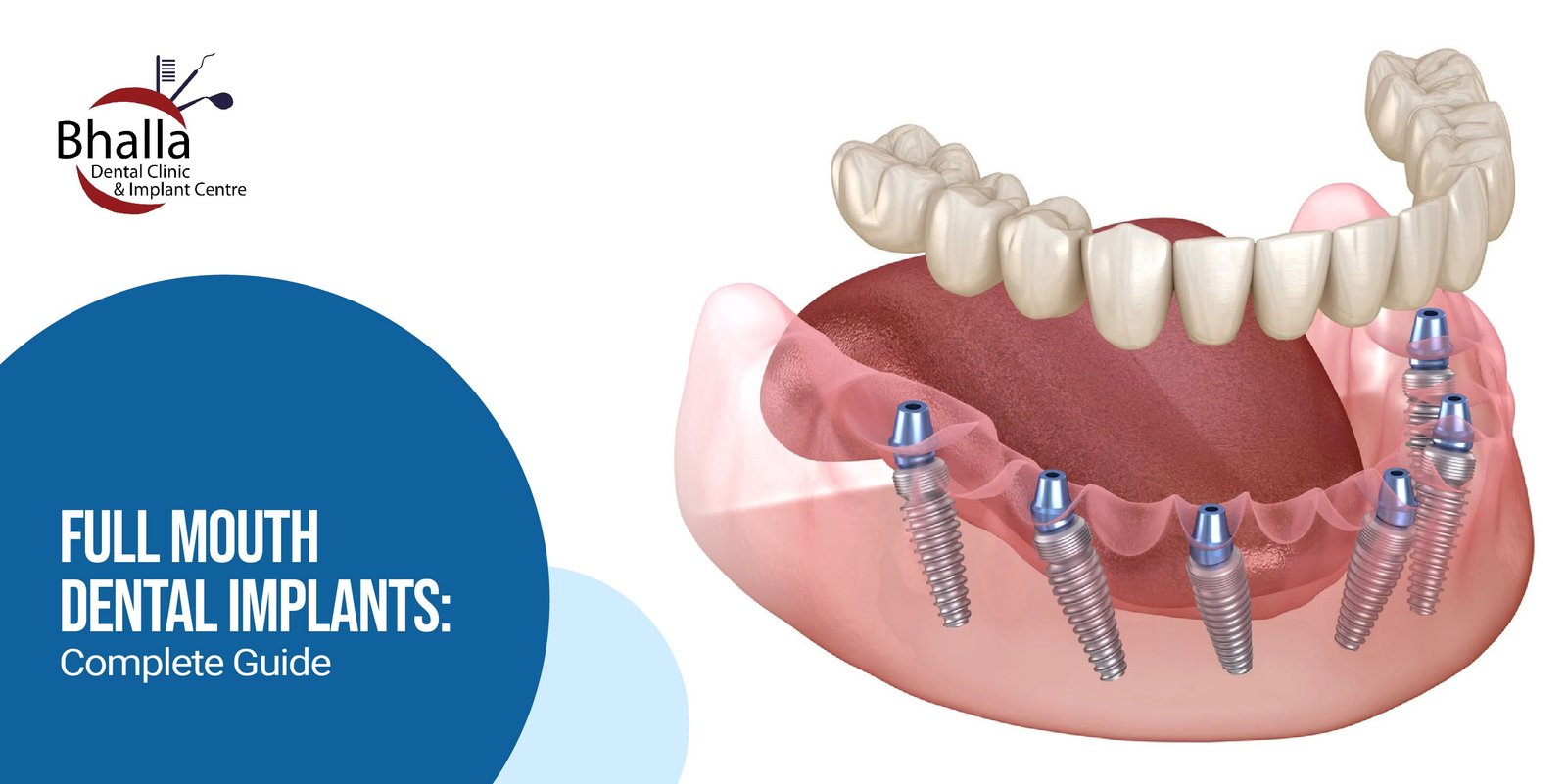 Full Mouth Dental Implants: A Complete Guide 