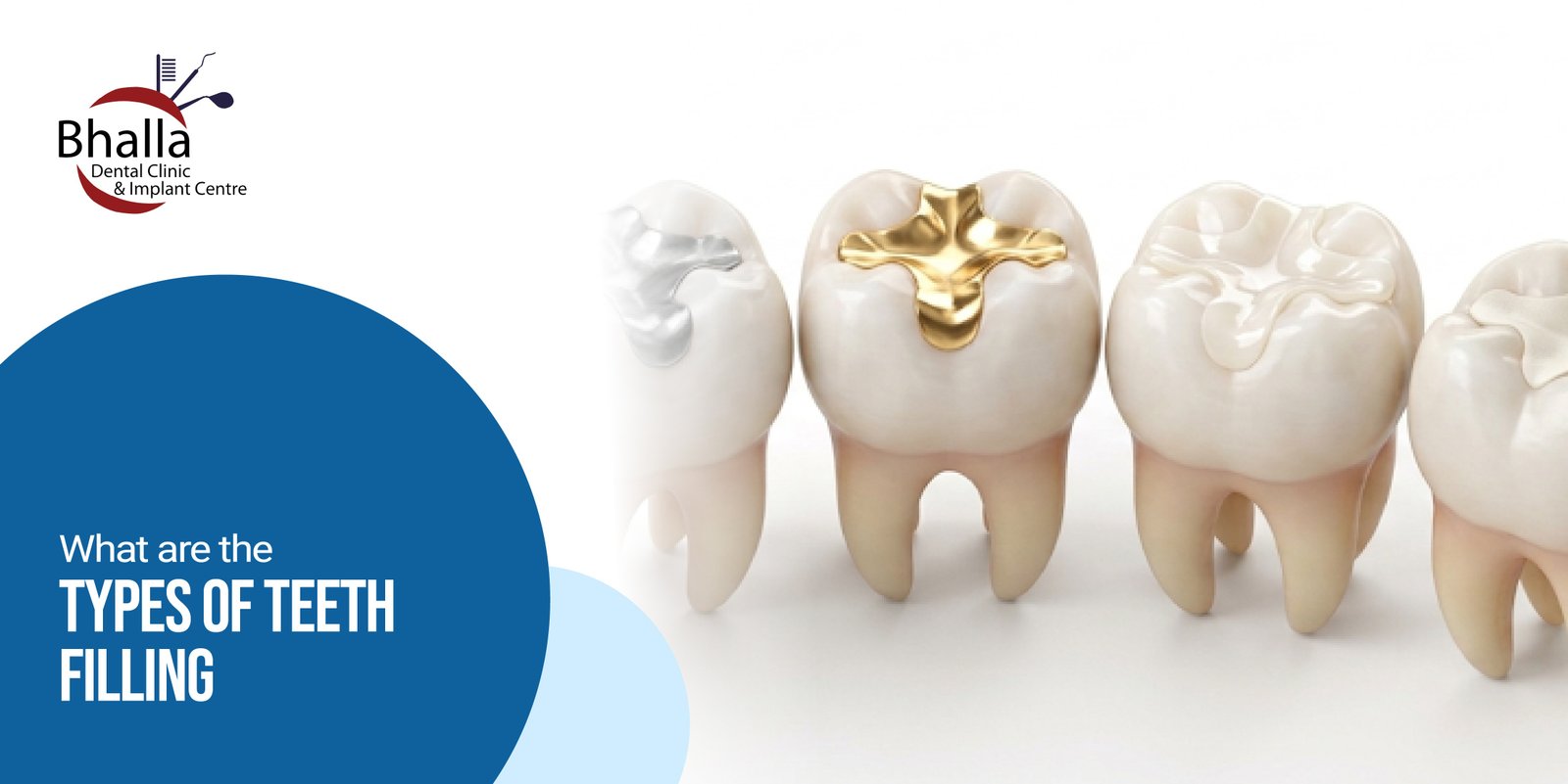 What Are the Types of Tooth Fillings?