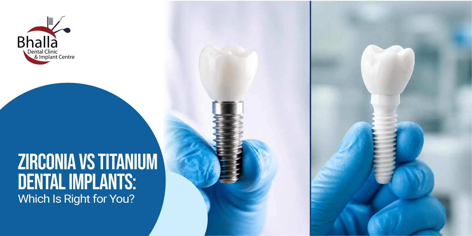 Zirconia vs Titanium Dental Implants
