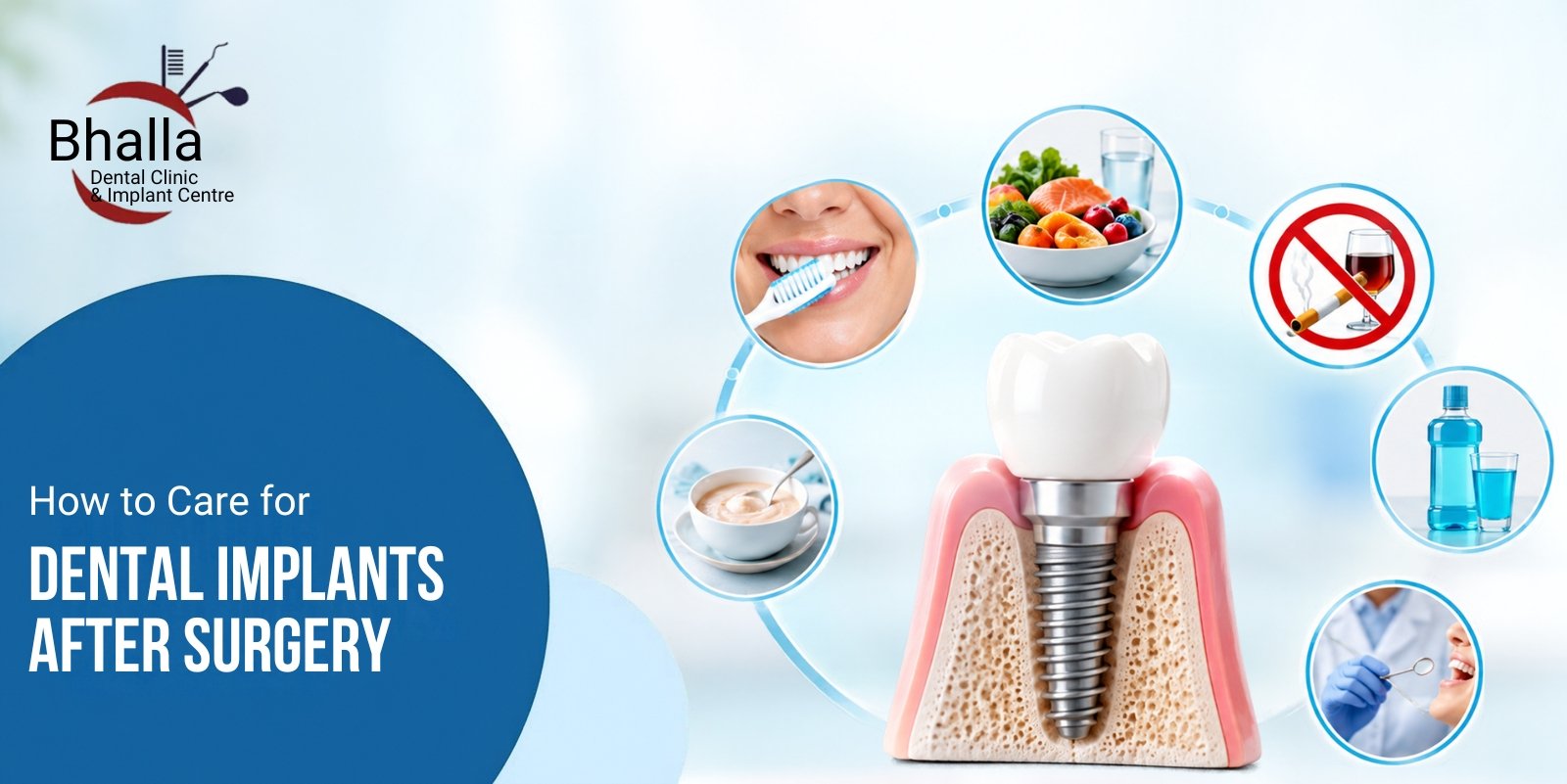 How to Care for Dental Implants After Surgery