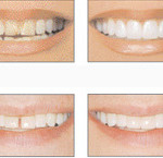 Tooth Contouring and Reshaping