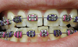 Orthobraces_dental_braces_lower_upper_jaw