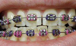 Clips / Braces - Thillai Dental Care