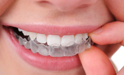 dental_braces