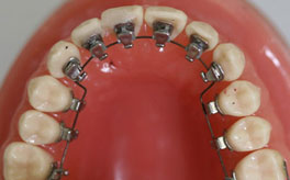 Clips / Braces - Thillai Dental Care
