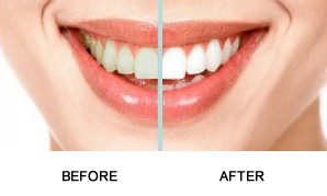 teeth-whitening-before-and-after
