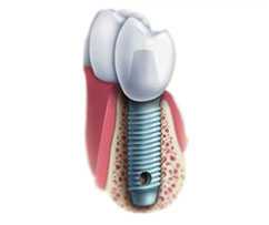 Dental Implant Titanium Screw