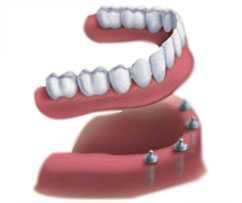 Dental Implant Crown