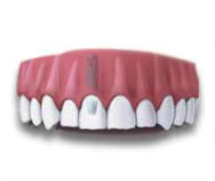 Dental Implant Abutment