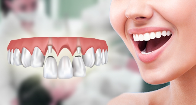teeth-replacement-options